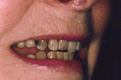 older teeth   before smile 