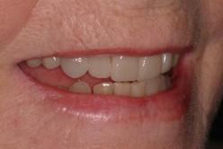 older teeth  after smile