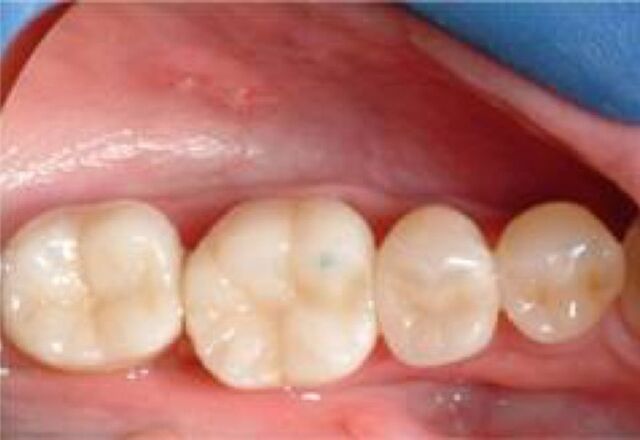 White fillings - after